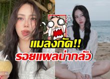 เปรี้ยว ทัศนียา โดนแมลงหมาร่ากัด แผลน่ากลัวขนาดนี้