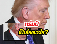 โซเชียลแห่แชร์ ทรัมป์เป็นโรคอะไร?มีแผลผื่นแดงหนารอบลำคอ